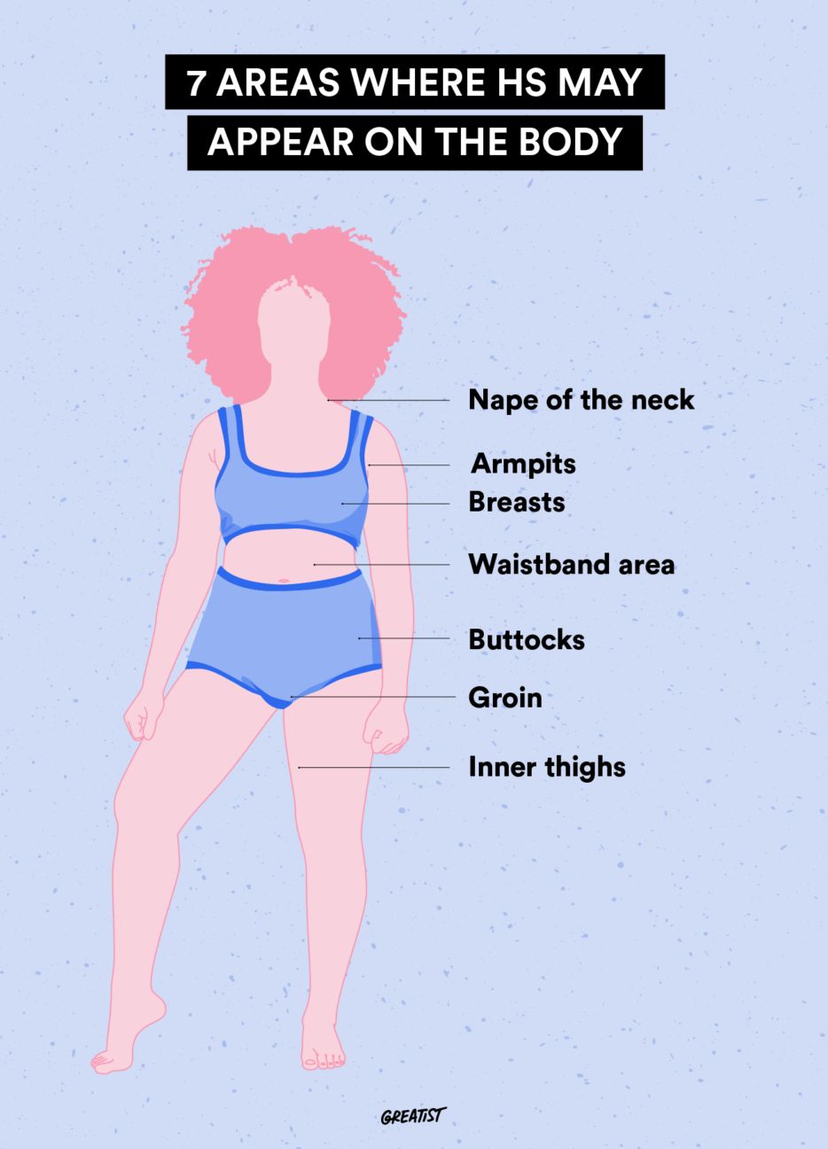 7 Places on the Body That Hidradenitis Suppurativa Can Appear