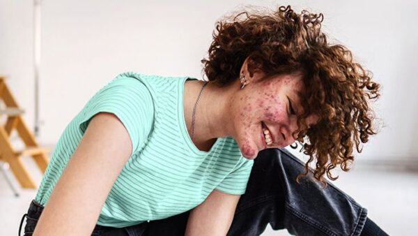 7 Common Misdiagnoses for Hidradenitis Suppurativa (HS) Review: A Must-Read Guide for Better Skin Health